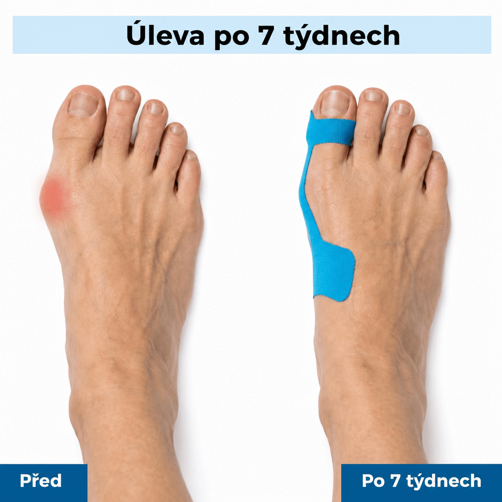 Tsunaya™ Tejp na vbočený palec - Tsunaya